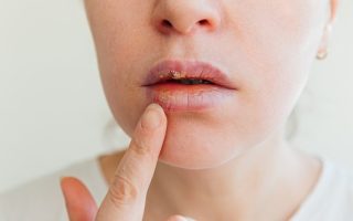 herpes na ústach