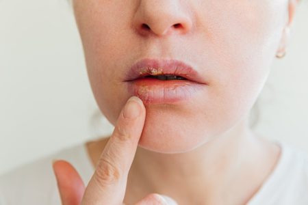 herpes na ústach