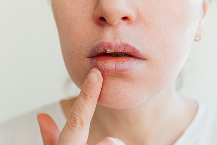 herpes na ústach